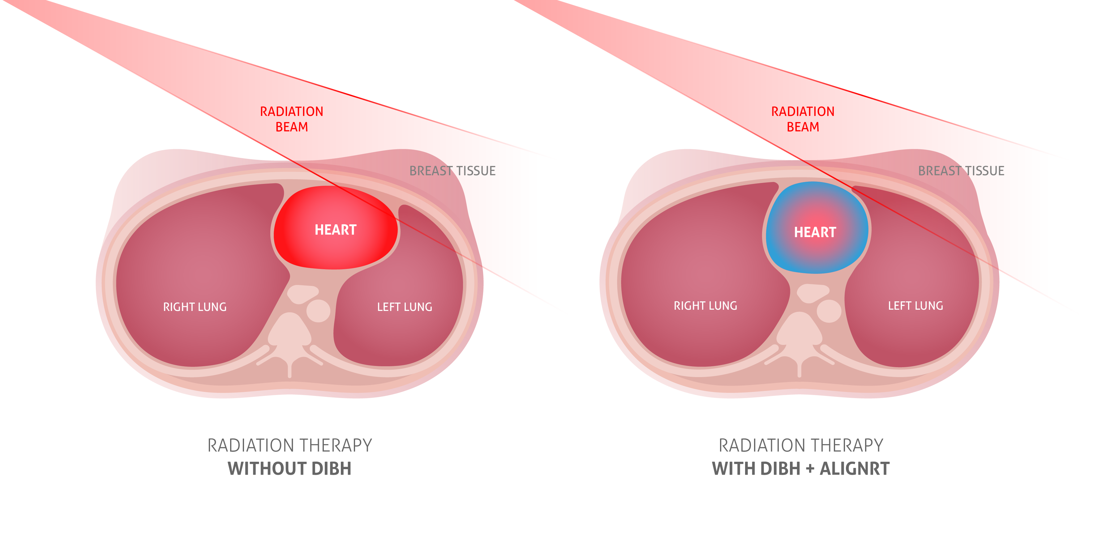 So, you have to get radiation therapy?